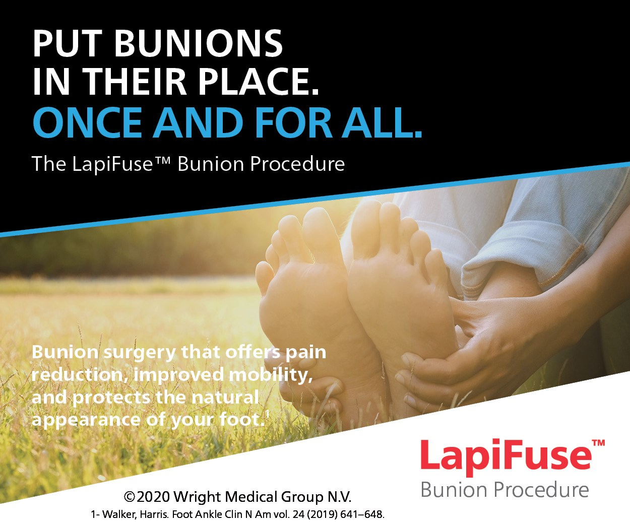 LapiFuse Bunion Procedure reduces pain and increased mobility